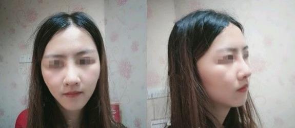 濱州醫(yī)學院附屬醫(yī)院做隆鼻一個月效果
