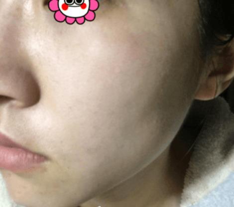 溫州韓美整形激光祛斑案例治療后一個月效果