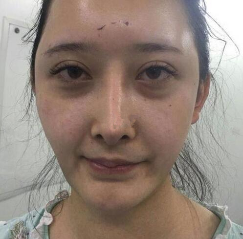 深圳陽光全臉填充術前效果