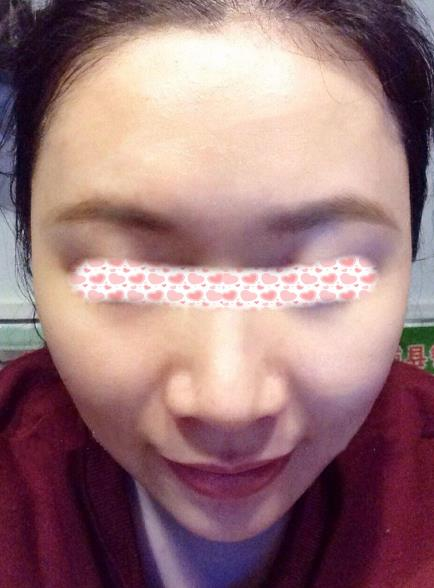 像我一樣寬鼻翼的小姐姐們可以放心找李旭平做隆鼻了，親測好評