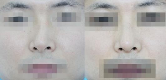 不要被營(yíng)銷號(hào)帶偏了，鼻骨矯正其實(shí)很簡(jiǎn)單