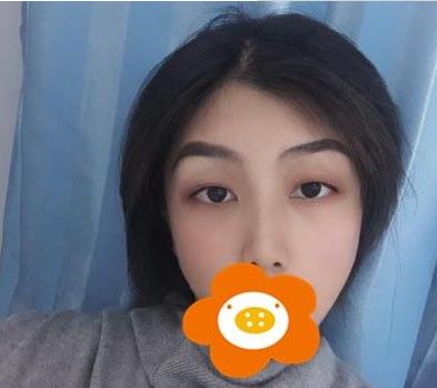 溫州韓美周杰群醫(yī)生耳軟骨隆鼻案例分享術后一個月效果