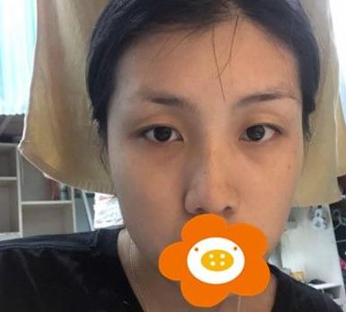 溫州韓美周杰群醫(yī)生耳軟骨隆鼻案例分享術前效果