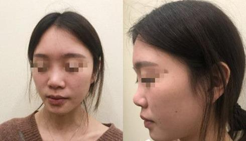 耳軟骨隆鼻術(shù)后三個月，我有了韓佳人同款美鼻