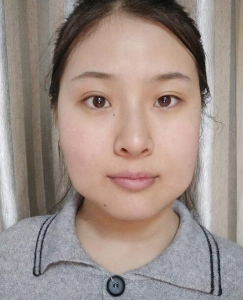 杭州時光磨骨前后對比，你整成這樣還缺王思聰嗎