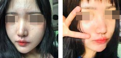 一個鼻子讓一張臉迅速高級，還不考慮做個鼻綜合嗎