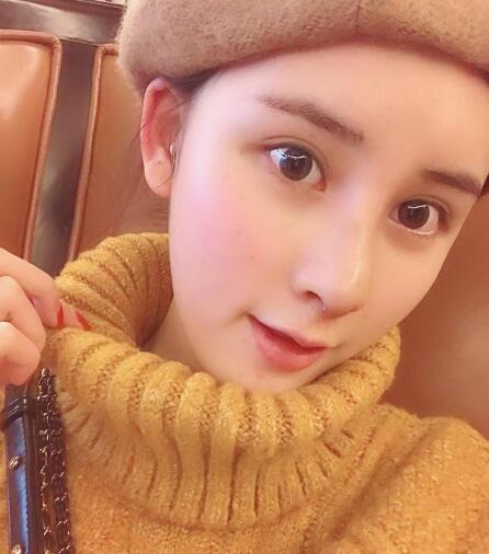蘭州美月做膨體隆鼻術(shù)后一個月效果