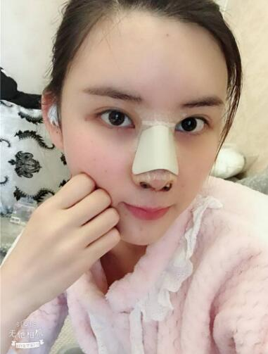 這么好的效果，不來蘭州美月做膨體隆鼻真是白瞎了醫(yī)生的技術(shù)