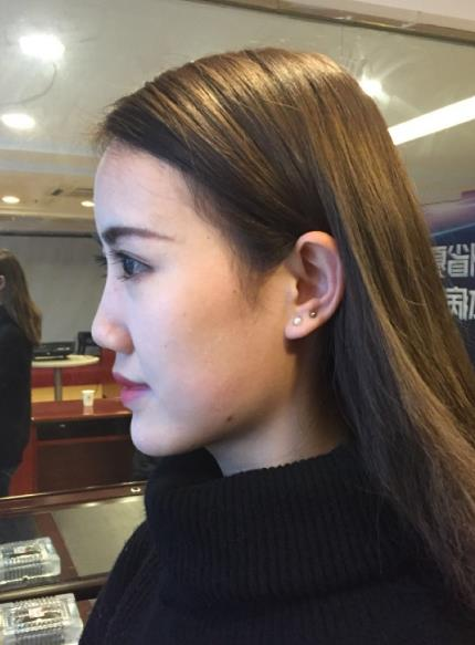 北京藝美整形鼻綜合案例分享，我都忍不住多看了兩眼