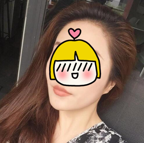 南京藝星整形趙海波面部吸脂一個月效果分享，有圖