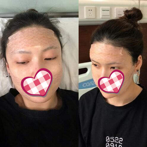 哈爾濱成美自體脂肪全臉填充案例術后第二天