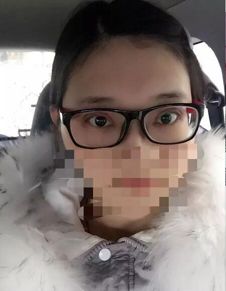 北京京民雙眼皮修復案例分享，說是媽生眼我都信