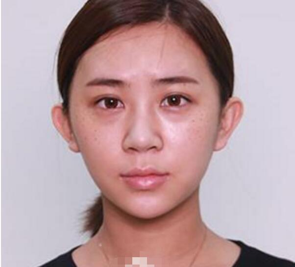 深圳鵬程整形劉冰做的鼻子真絕了，跟我想象的一模一樣