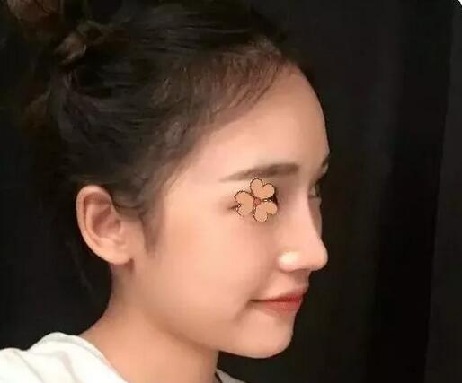 深圳福華整形陳貞宜超體隆鼻術后一個月效果反饋，有圖