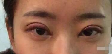武漢藝星整形岳金堂醫(yī)生雙眼皮案例術(shù)后一周