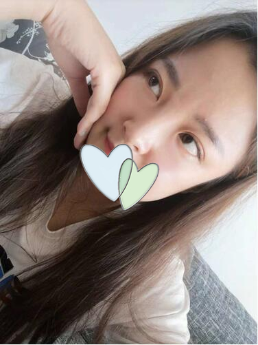 濟南韓式整形雙眼皮術(shù)后一個月