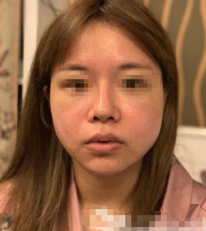南京閱顏整形瘦臉針注射前