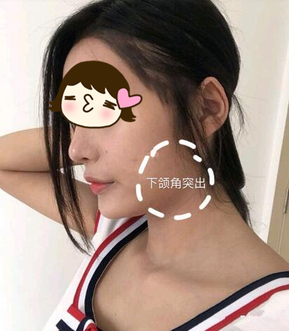 廣州美恩整形下頜角術(shù)前