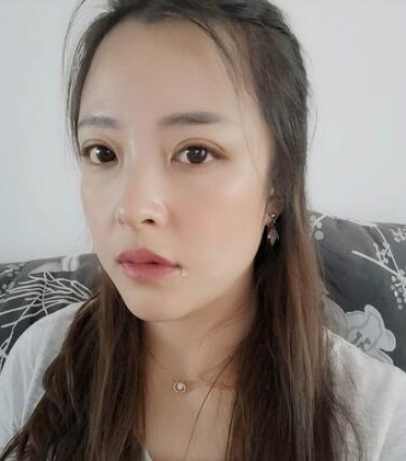濟(jì)南韓式整形雙眼皮案例分享，單看術(shù)后半個(gè)月效果還以為手術(shù)失敗了