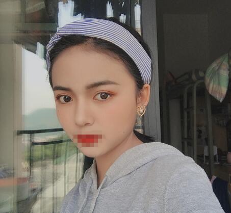 長(zhǎng)沙愛(ài)思特整形定點(diǎn)雙眼皮一個(gè)月