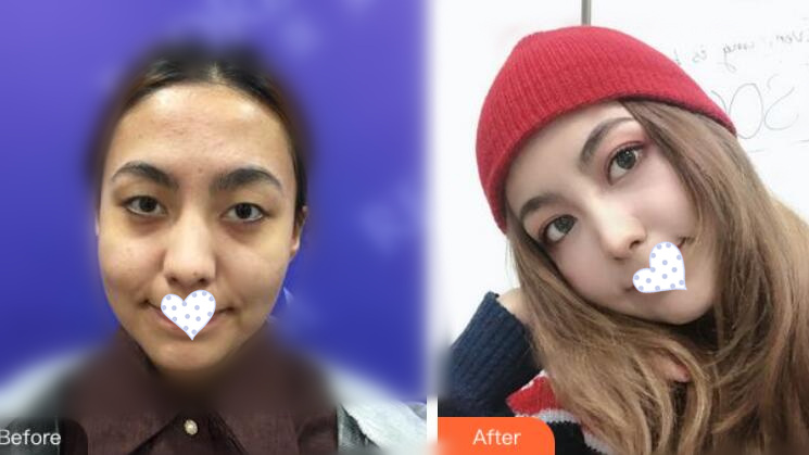 徐州時(shí)光洪揚(yáng)整形雙眼皮案例分享，好看到詞窮