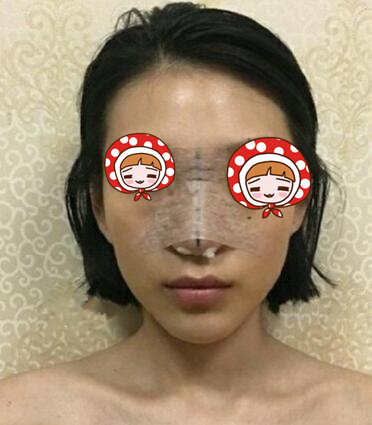 青島華諾整形歪鼻矯正術后第二天