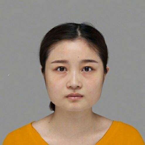 重慶美聯(lián)臣下頜角整形術(shù)后三個(gè)月效果反饋，一定要忌嘴