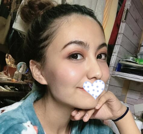 徐州時光洪揚整形雙眼皮術(shù)后一個月效果