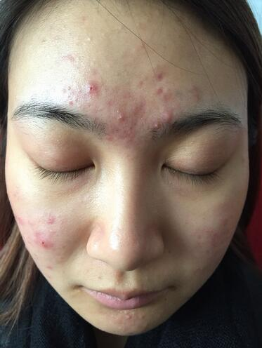 合肥艾雅整形紅藍(lán)光祛痘兩個(gè)療程效果，痘痘都消失了