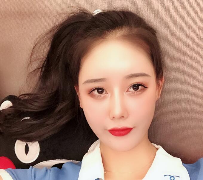 長沙亞韓整形陳明松下頜角整形一個月效果