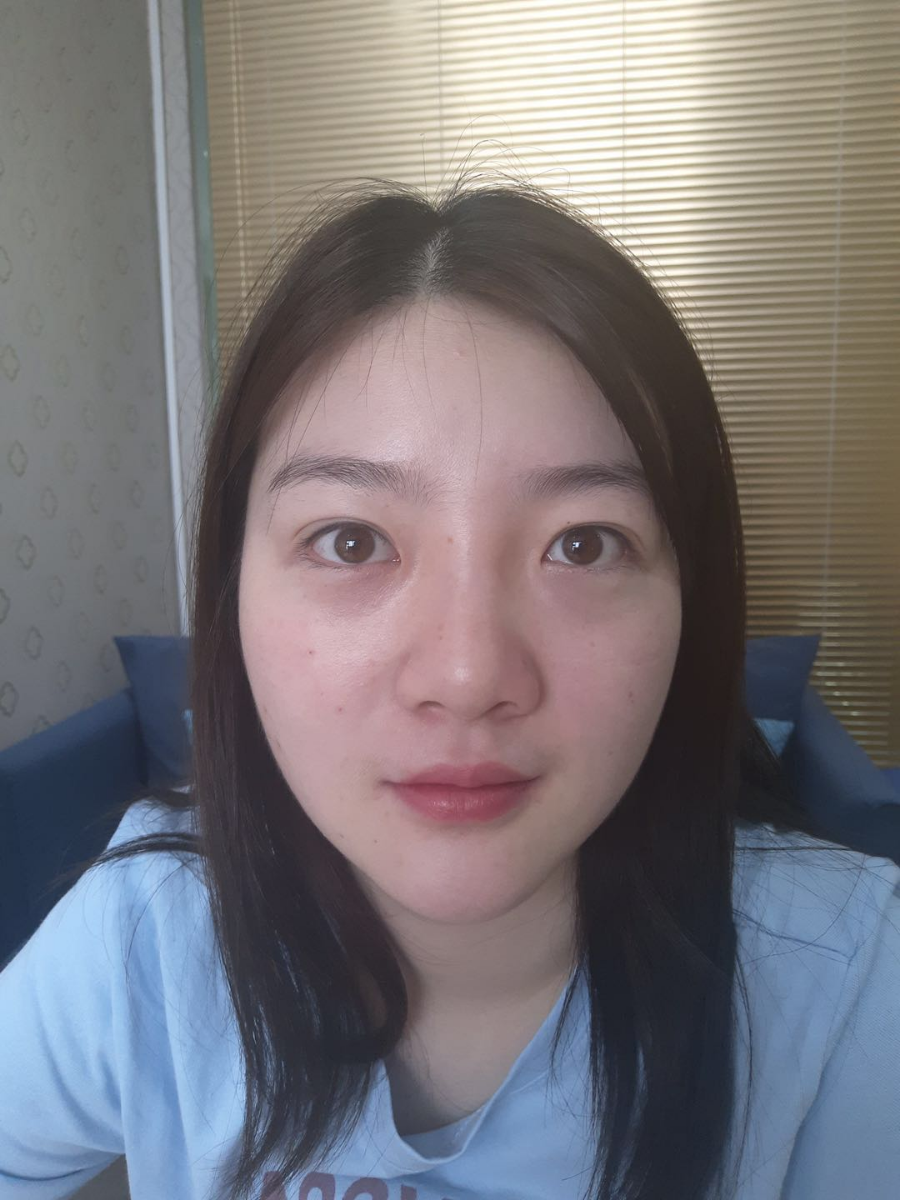 北京圣嘉榮二次鼻修復(fù)案例分享，做整形一定不要去莆田系醫(yī)院