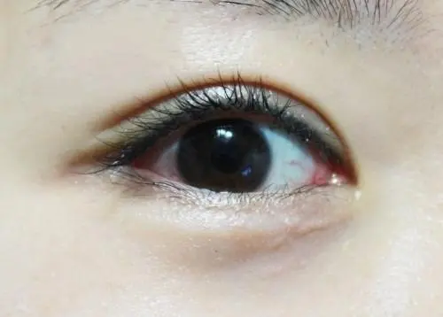 埋線雙眼皮