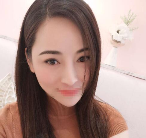 赤峰現(xiàn)代婦產(chǎn)醫(yī)院醫(yī)療美容科袁俊龍雙眼皮修復(fù)術(shù)后一個月