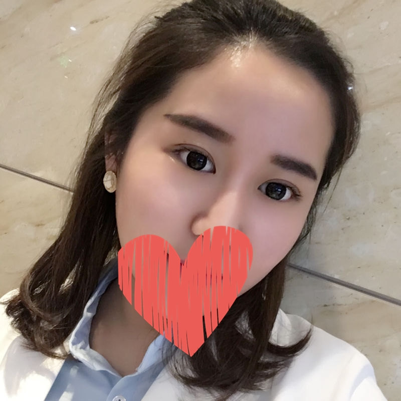 滄州中妤整形張明切開雙眼皮兩個月效果