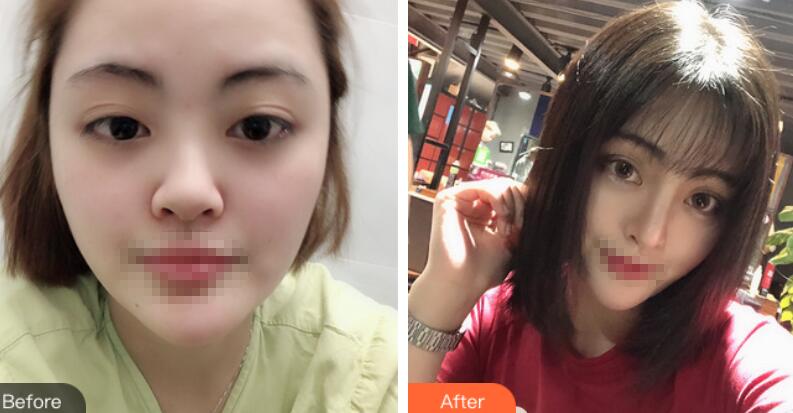 上海賽美瑞整形張化舉鼻綜合前后對(duì)比圖
