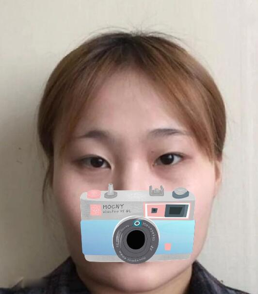 重慶華美整形下頜角整形術后三個月效果分享