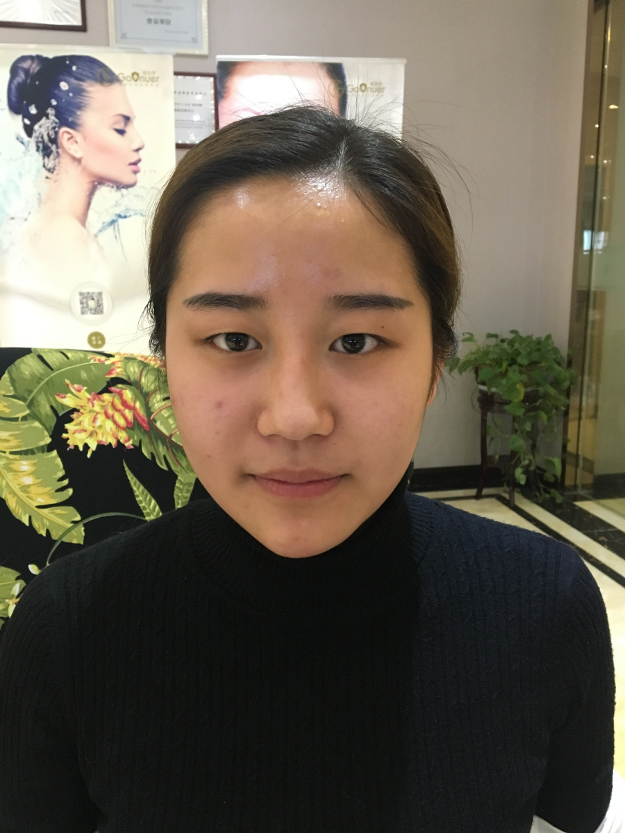 滄州中妤整形張明切開雙眼皮案例分享