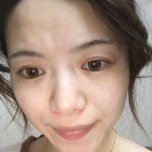 邯鄲佑熙整形孫堅激光祛斑半個月效果