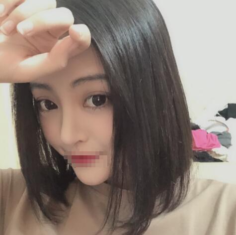 上海賽美瑞整形張化舉鼻綜合兩個(gè)月效果