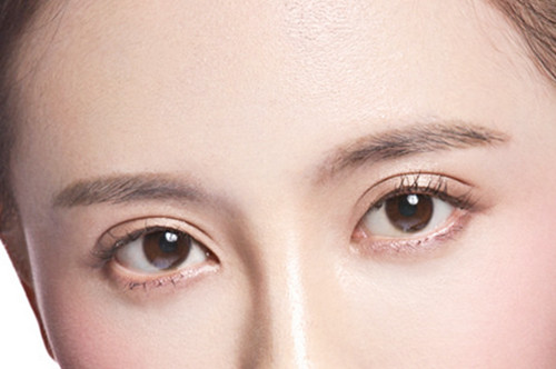 菏澤華美整形美容醫(yī)院開內眼角術后效果