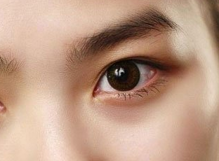 合肥龐博整形美容醫(yī)院做開眼角術(shù)后效果