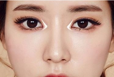 江門僑都華美整形美容醫(yī)院開(kāi)內(nèi)眼角