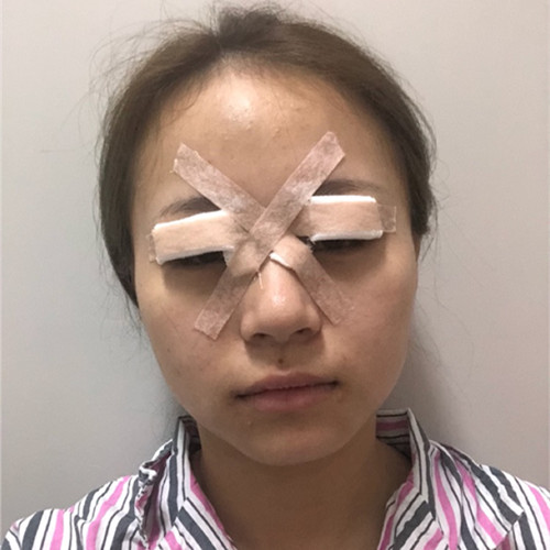杭州靜港林忠泵埋線雙眼皮案例1-7天效果圖分享，讓你的眼睛魅力四射