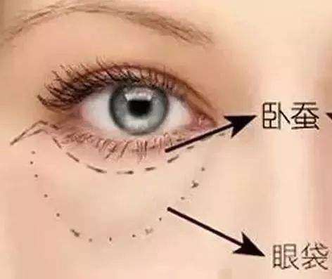 南充艾迪整形美容醫(yī)院吸脂祛眼袋