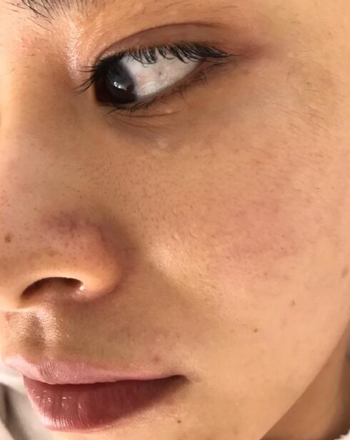 福州愛(ài)思特比華利整形林秋蓉醫(yī)生做光子嫩膚過(guò)程體驗(yàn)！皮膚Q彈