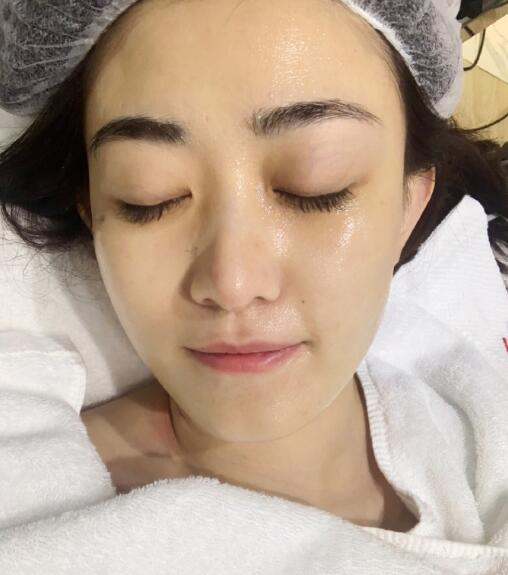 贛州韓美整形吳彩霞果酸換膚效果對比圖