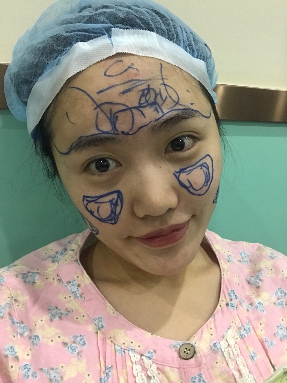 北京星美李寧輝進(jìn)口膨體隆鼻案例