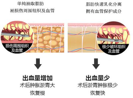 環(huán)形吸脂減肥手術(shù)原理介紹：