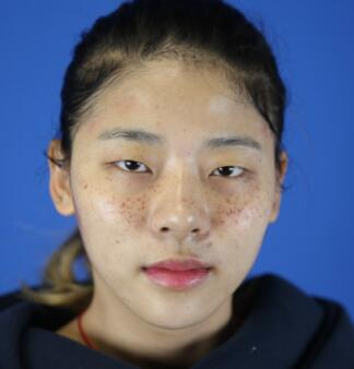 福州愛(ài)思特比華利整形林秋榮激光祛斑效果太贊了，終于沒(méi)人叫我“斑花”了