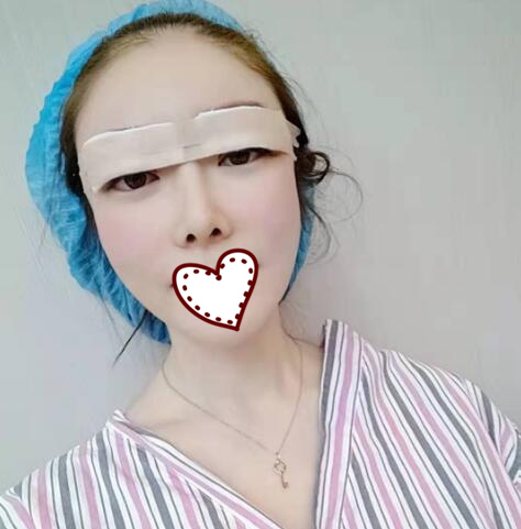 北京亞奇龍醫(yī)療整形醫(yī)生陳煥然雙眼皮案例效果對(duì)比圖